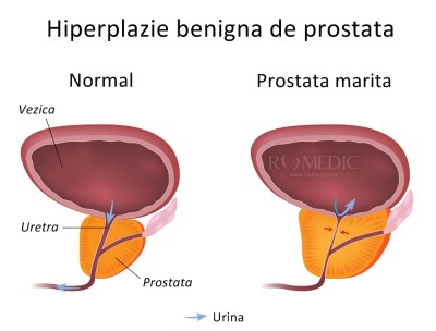 hiperplaziei benigne de prostată